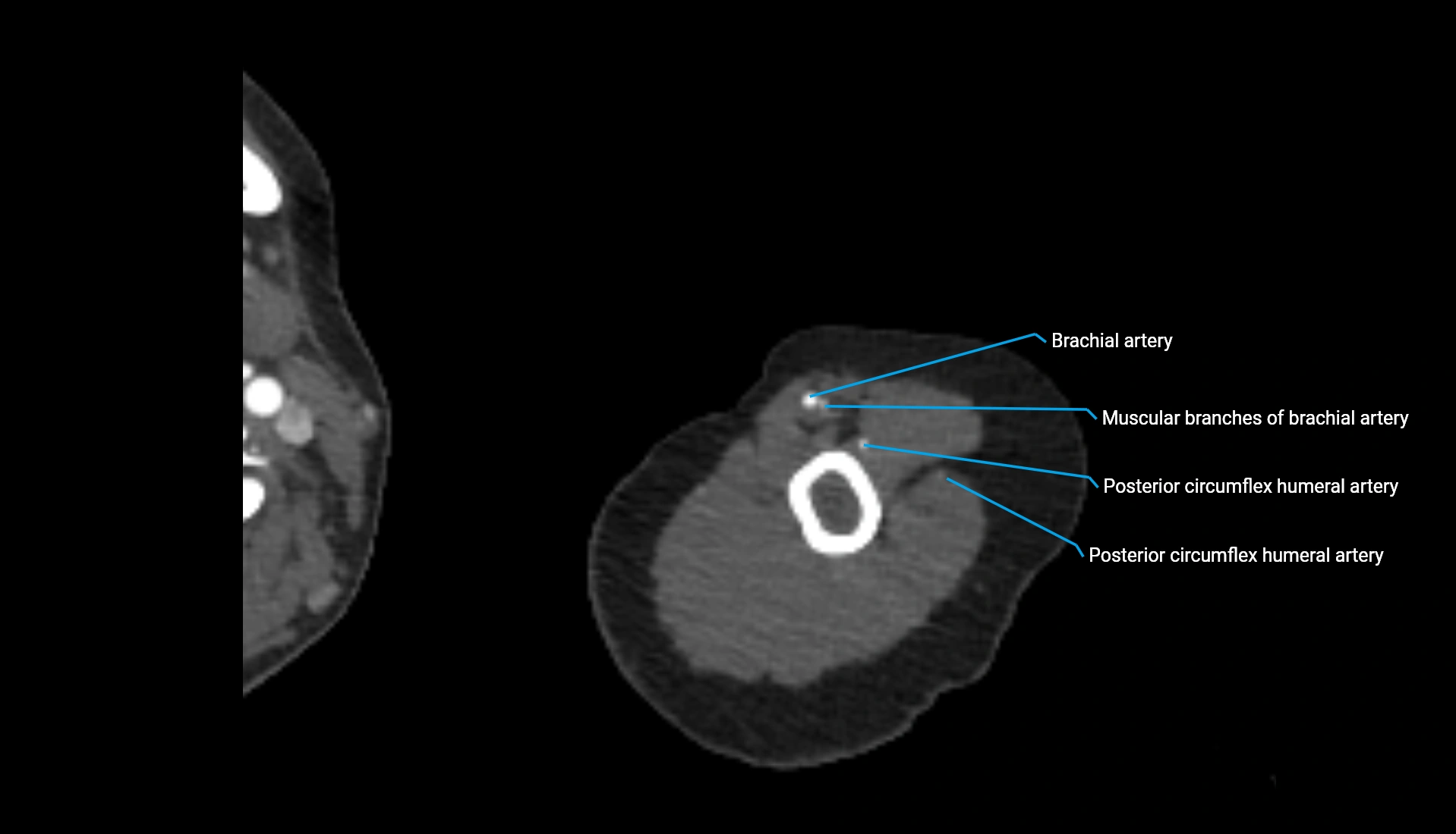 CTA upper limb axial cross sectional anatomy labelled image 299 (2).webp
